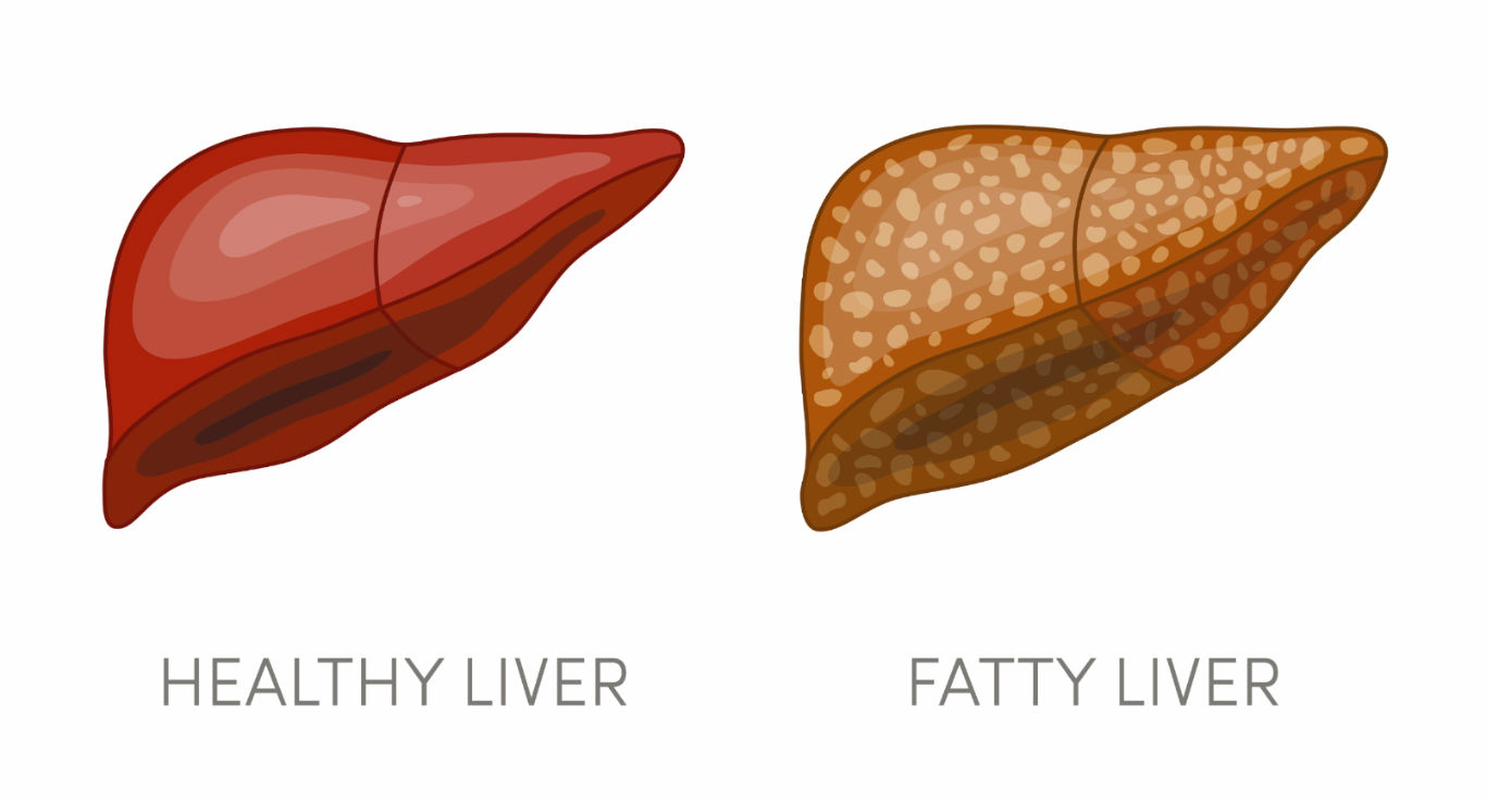 fatty liver treatment in indore, best liver doctor in indore