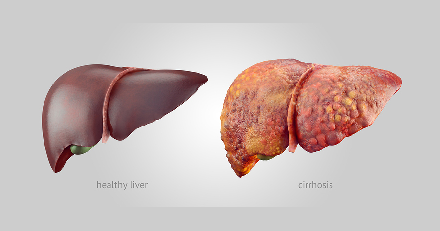 liver cirrhosis treatment in indore, liver specialist in indore