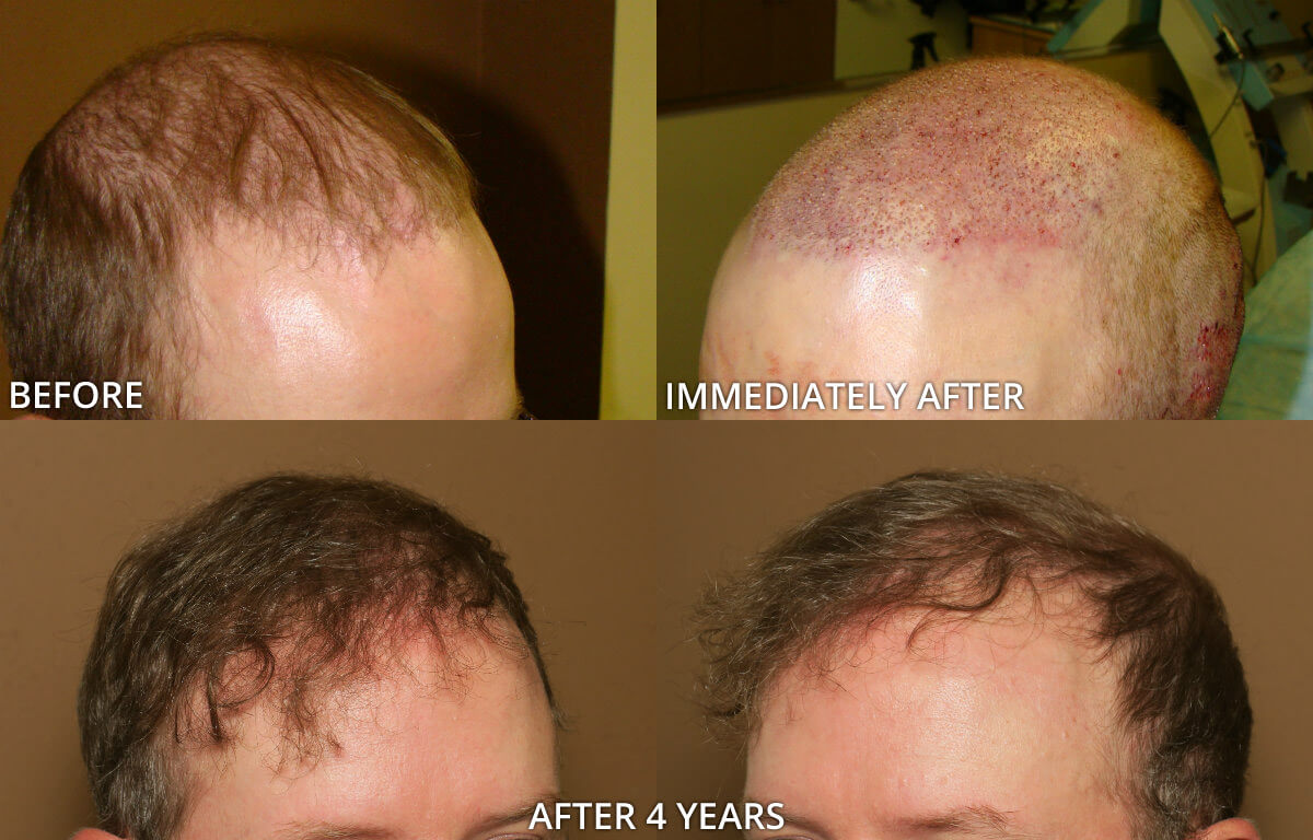 hair-transplant-before-and-after